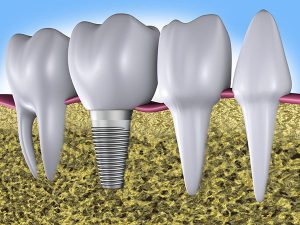 Dental Implants | Dentist Castlemaine