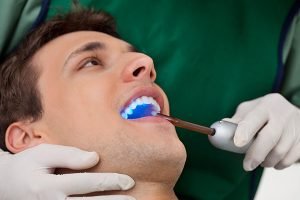 Fissure Sealants | Dentist Castlemaine
