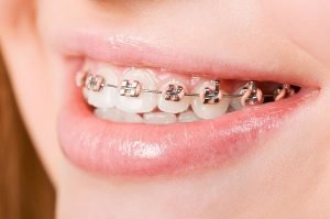 Orthodontics | Dentist Castlemaine