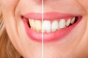 Teeth Whitening | Dentist Castlemaine