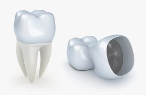 Castlemaine Smiles Dentist | Do Permanent Crowns Last Forever | Dentist Castlemain
