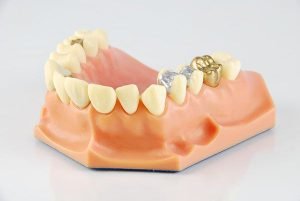 Lost Fillings Crown Or Inlay Onlay | Dentist Castlemaine